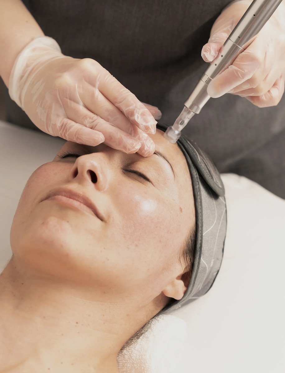 Microdermabrasion 1